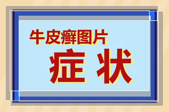 女儿说他的男友患有银屑病自己要不要嫁来询问我