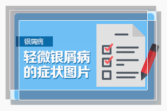 请问牛皮癣患者可以经常吃牛肉吗，还能吃什么