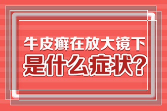 贵州去哪看银屑病医院好怎样分辨