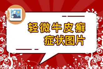 牛皮癣的外用药治不好？为什么不能单 使用外用药？