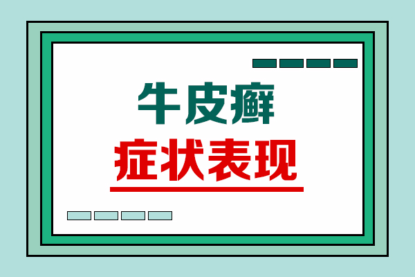 外用药膏治疗:银屑病患者应该注意这些