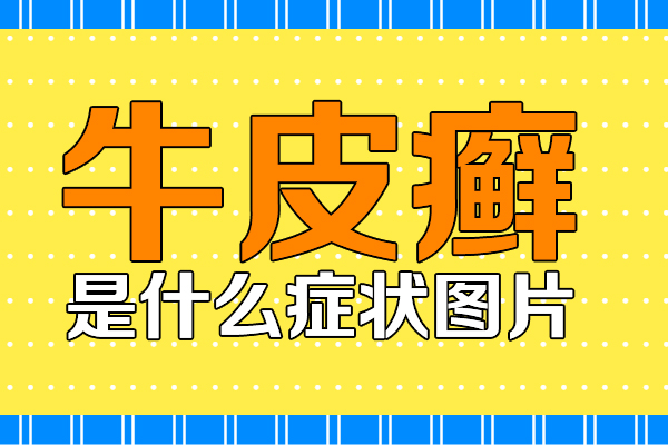 皮肤出现4种异样，警惕牛皮癣来袭!牛皮癣症状图片.