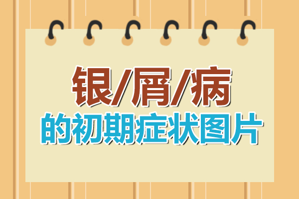 牛皮藓的早期症状图片，牛皮藓要怎么辨别呢?