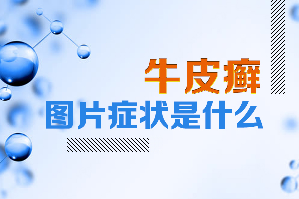 贵州治疗银屑病去哪个专业医院好-如何做好而童银屑病的护理和治疗