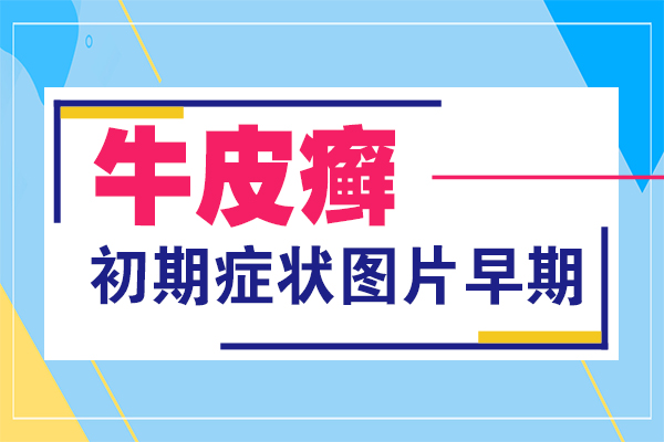 牛皮皮癣图片-牛皮癣早期常见的症状表现(点击详细查看)